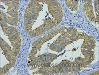 Immunohistochemistry of paraffin-embedded Human colon cancer tissue using CK-8 Monoclonal Antibody at dilution of 1:200.