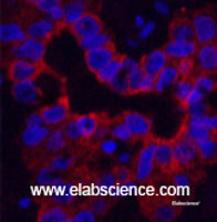 Immunofluorescence analysis of Human liver cancer tissue using CK-16 Monoclonal Antibody at dilution of 1:200.