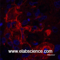 Immunofluorescence analysis of Human lung cancer tissue using CD66e Monoclonal Antibody at dilution of 1:200.