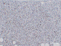 Immunohistochemistry of paraffin-embedded Human Plasmacytoma using KI67 Monoclonal Antibody at dilution of 1:200.