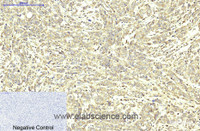 Immunohistochemistry of paraffin-embedded Human breast cancer tissue using ABCB5 Monoclonal Antibody at dilution of 1:200.