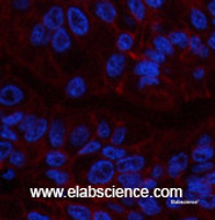 Immunofluorescence analysis of Human liver cancer tissue using CA9 Monoclonal Antibody at dilution of 1:200.
