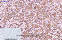 Immunohistochemistry of paraffin-embedded Human breast cancer tissue using CK-6A/B/C Monoclonal Antibody at dilution of 1:200.