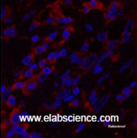 Immunofluorescence analysis of Human breast cancer tissue using CK-6A/B/C Monoclonal Antibody at dilution of 1:200.