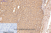 Immunohistochemistry of paraffin-embedded Human liver cancer tissue using IDE Monoclonal Antibody at dilution of 1:200.