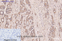 Immunohistochemistry of paraffin-embedded Human liver cancer tissue using CD5 Monoclonal Antibody at dilution of 1:200.
