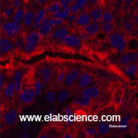 Immunofluorescence analysis of Human liver cancer tissue using CD15 Monoclonal Antibody at dilution of 1:200.