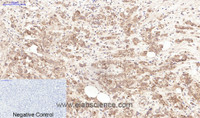 Immunohistochemistry of paraffin-embedded Human breast cancer tissue using LTF Monoclonal Antibody at dilution of 1:200.