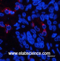 Immunofluorescence analysis of Human lung cancer tissue using LTF Monoclonal Antibody at dilution of 1:200.