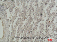 Immunohistochemistry of paraffin-embedded Human lung carcinoma tissue with CREB1 Monoclonal Antibody