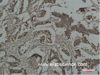 Immunohistochemistry of paraffin-embedded Human breast carcinoma tissue using HSP27 Monoclonal Antibody at dilution of 1:200.
