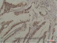 Immunohistochemistry of paraffin-embedded Human breast carcinoma tissue using HSPA8 Monoclonal Antibody at dilution of 1:200.