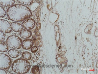 Immunohistochemistry of paraffin-embedded Human colon carcinoma tissue using HSPA5 Monoclonal Antibody at dilution of 1:200.