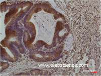 Immunohistochemistry of paraffin-embedded Human colon carcinoma tissue using Smad3 Monoclonal Antibody at dilution of 1:200.