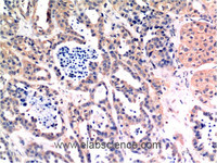 Immunohistochemistry of paraffin-embedded Human breast carcinoma tissue using Bax Monoclonal Antibody at dilution of 1:200.