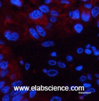 Immunofluorescence analysis of Human liver cancer tissue using CST3 Monoclonal Antibody at dilution of 1:200.