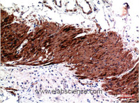 Immunohistochemistry of paraffin-embedded Human colon carcinoma tissue using ACTA1 Monoclonal Antibody at dilution of 1:200.
