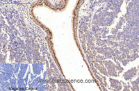 Immunohistochemistry of paraffin-embedded Human lung cancer tissue using COL1A1 Monoclonal Antibody at dilution of 1:200.