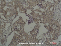 Immunohistochemistry of paraffin-embedded Human breast carcinoma tissue using c-Fos Monoclonal Antibody at dilution of 1:200.