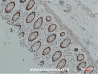 Immunohistochemistry of paraffin-embedded Human colon carcinoma tissue using HSP90 alpha Monoclonal Antibody at dilution of 1:200.