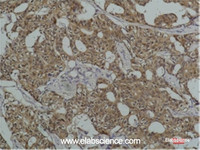 Immunohistochemistry of paraffin-embedded Human breast carcinoma tissue using HSPA8 Monoclonal Antibody at dilution of 1:200.