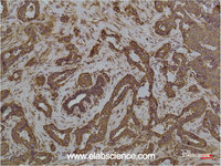 Immunohistochemistry of paraffin-embedded Human breast carcinoma tissue using HSPA5 Monoclonal Antibody at dilution of 1:200.