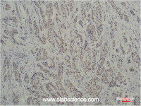 Immunohistochemistry of paraffin-embedded Human breast carcinoma tissue using TBP Monoclonal Antibody at dilution of 1:200.