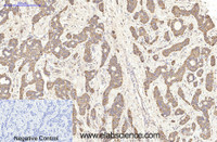 Immunohistochemistry of paraffin-embedded Human liver cancer tissue using NFKBIB Monoclonal Antibody at dilution of 1:200.