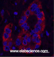 Immunofluorescence analysis of Human liver cancer tissue using NFKBIB Monoclonal Antibody at dilution of 1:200.