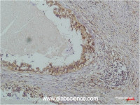 Immunohistochemistry of paraffin-embedded Human lung carcinoma tissue using NFKBIB Monoclonal Antibody at dilution of 1:200.