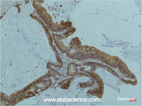 Immunohistochemistry of paraffin-embedded Human colon carcinoma tissue using Smad3 Monoclonal Antibody at dilution of 1:200.