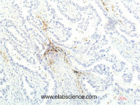 Immunohistochemistry of paraffin-embedded Human lung carcinoma tissue using JAK1 Monoclonal Antibody at dilution of 1:200.