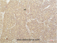 Immunohistochemistry of paraffin-embedded Human kidney carcinoma tissue using SGK1 Monoclonal Antibody at dilution of 1:200.