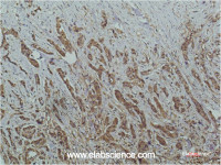 Immunohistochemistry of paraffin-embedded Human breast carcinoma tissue using HDAC1 Monoclonal Antibody at dilution of 1:200.