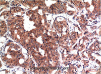 Immunohistochemistry of paraffin-embedded Human breast carcinoma tissue using GSK3 beta Monoclonal Antibody at dilution of 1:200.