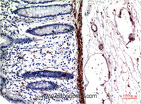 Immunohistochemistry of paraffin-embedded Human colon carcinoma tissue using ACTA1 Monoclonal Antibody at dilution of 1:200.