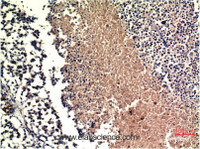 Immunohistochemistry of paraffin-embedded Human lung carcinoma tissue using PTEN Monoclonal Antibody at dilution of 1:200.