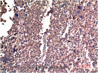 Immunohistochemistry of paraffin-embedded Human lung carcinoma tissue using Cyclin B1 Monoclonal Antibody at dilution of 1:200.