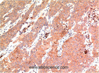 Immunohistochemistry of paraffin-embedded Human breast carcinoma tissue using Epsilon Tubulin Monoclonal Antibody at dilution of 1:200.