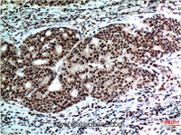 Immunohistochemistry of paraffin-embedded Human breast carcinoma tissue using BECN1 Monoclonal Antibody at dilution of 1:200.