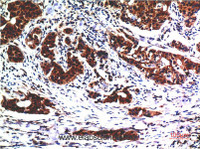 Immunohistochemistry of paraffin-embedded Human breast carcinoma tissue using AKT1 Monoclonal Antibody at dilution of 1:200.