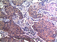 Immunohistochemistry of paraffin-embedded Human breast carcinoma tissue using MMP2 Monoclonal Antibody at dilution of 1:200.