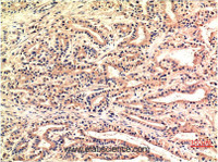 Immunohistochemistry of paraffin-embedded Human stomach carcinoma tissue using CHOP Monoclonal Antibody at dilution of 1:200.