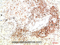 Immunohistochemistry of paraffin-embedded Human lung carcinoma tissue using JAK2 Monoclonal Antibody at dilution of 1:200.