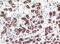 Immunohistochemistry of paraffin-embedded Human breast carcinoma tissue with Phospho-ERK 1/2 (Tyr222/205) Monoclonal Antibody at dilution of 1:200