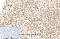 Immunohistochemistry of paraffin-embedded Human breast cancer tissue using Cleaved-CASP1 (D210) Polyclonal Antibody at dilution of 1:200.