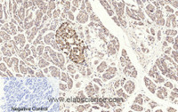 Immunohistochemistry of paraffin-embedded Human stomach cancer tissue using Cleaved-CASP3 p17 (D175) Polyclonal Antibody at dilution of 1:200.