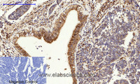 Immunohistochemistry of paraffin-embedded Human lung cancer tissue using CANX Polyclonal Antibody at dilution of 1:200.