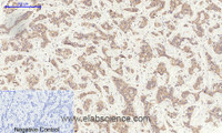 Immunohistochemistry of paraffin-embedded Human liver cancer tissue using GSK3 beta Polyclonal Antibody at dilution of 1:200.