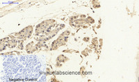 Immunohistochemistry of paraffin-embedded Human stomach cancer tissue using NFκB-p65 Polyclonal Antibody at dilution of 1:200.